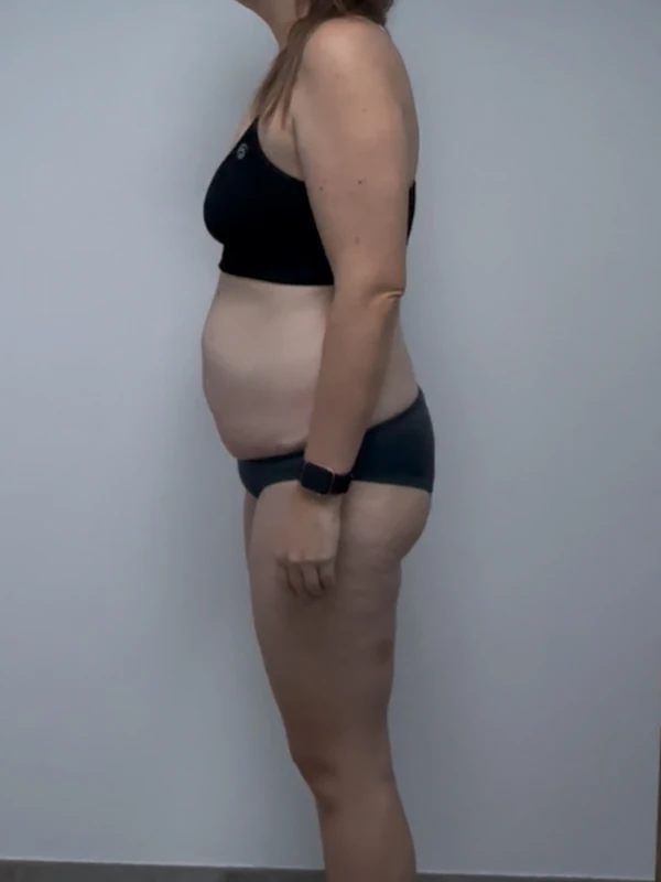 Milena K. – Vorher